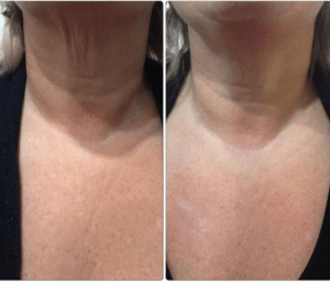 skintech radiofrequency before and after picture