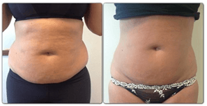 fat freezing before and after
